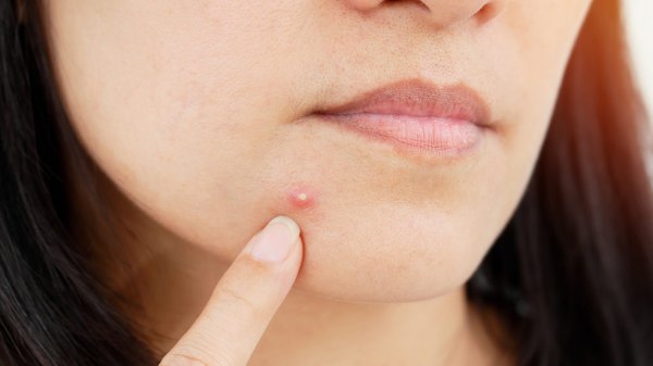 HOME REMEDIES THAT WILL HELP YOU TO GET RID OF PIMPLE OR ACNE
