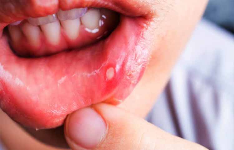 Say bye-bye to your mouth ulcers by using these easy steps