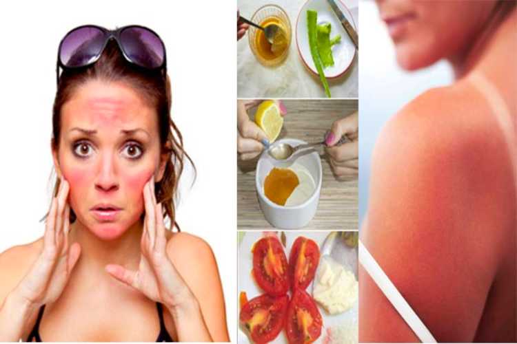 Use these home remedies for removing sunburn