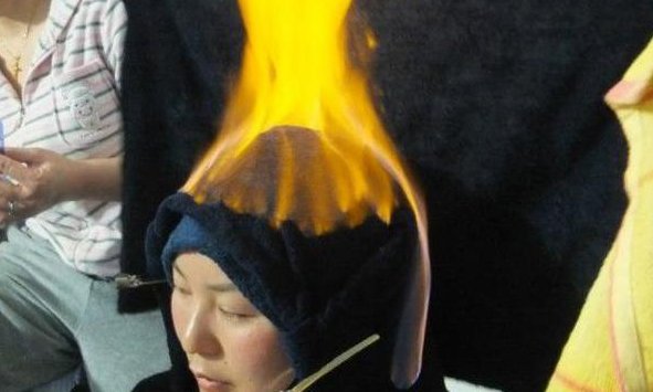 In this country people apply fire therapy for the treatment of the disease