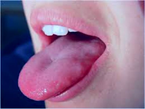 What if your tongue size will increase?